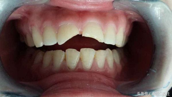 门牙磕掉一丢丢可以长回去吗,2岁宝宝门牙磕掉了一角怎么补