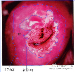 治疗“宫颈糜烂”，这个药被滥用了很多年