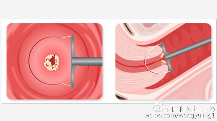 治疗“宫颈糜烂”，这个药被滥用了很多年