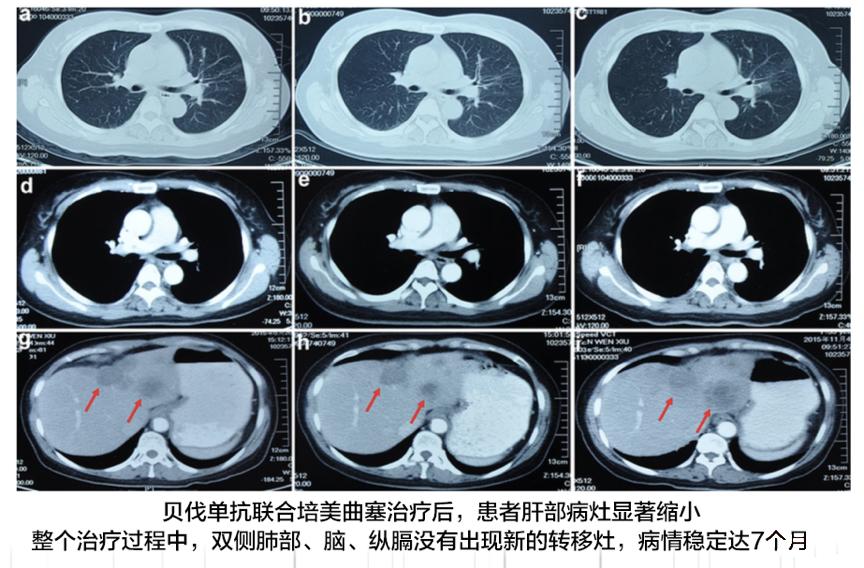 alk阳性肺癌耐药成功案例,肺癌alk阳性晚期能痊愈吗