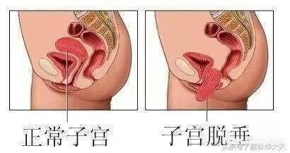 产后怎么预防子宫下垂,产后怎么防止子宫下坠