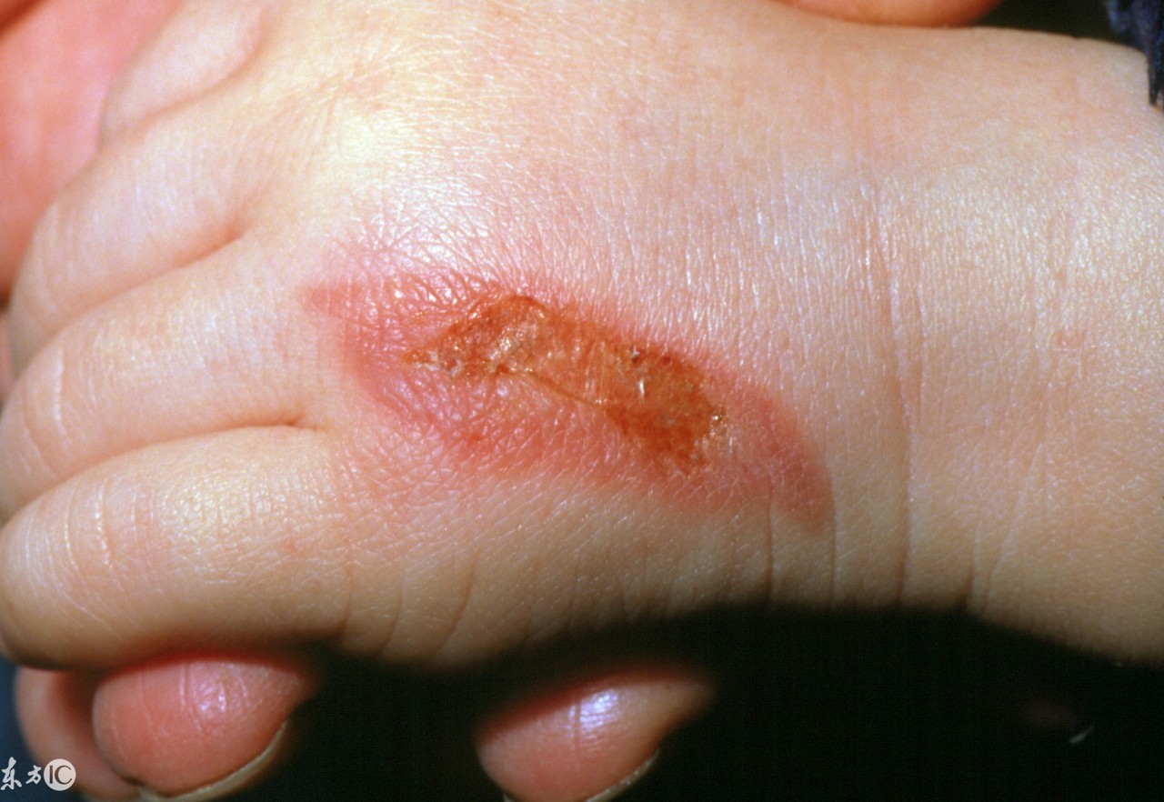 被开水烫伤后该怎么说,被开水烫伤后饮食注意事项