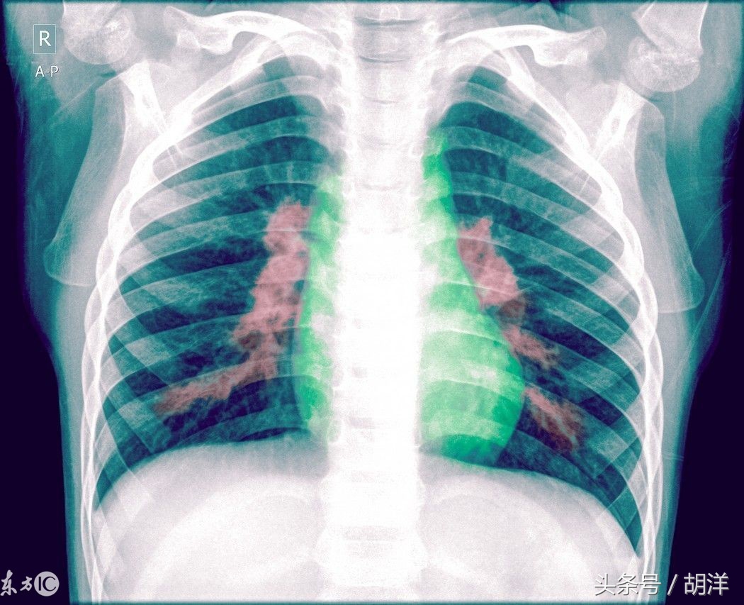 肺炎所致的感染性休克应观察什么,肺炎一定会出现的症状