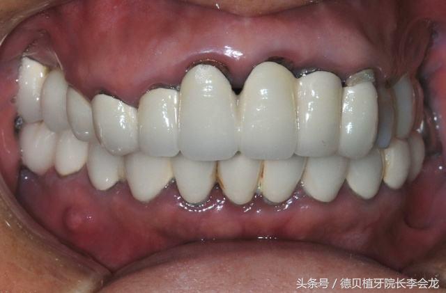 烤瓷牙表面掉瓷了对人身体有害吗,小加工厂做的烤瓷牙对身体有害吗