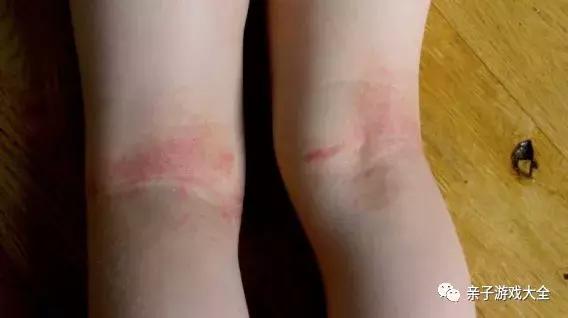 每年复发的湿疹用什么药膏,湿疹留下的色素沉淀擦什么药膏好