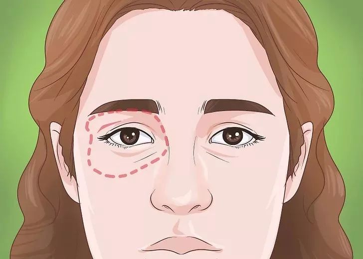 自测黑眼圈与什么疾病有关,黑眼圈越来越重了是有什么疾病吗