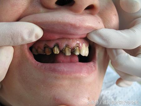 烤瓷牙表面掉瓷了对人身体有害吗,小加工厂做的烤瓷牙对身体有害吗