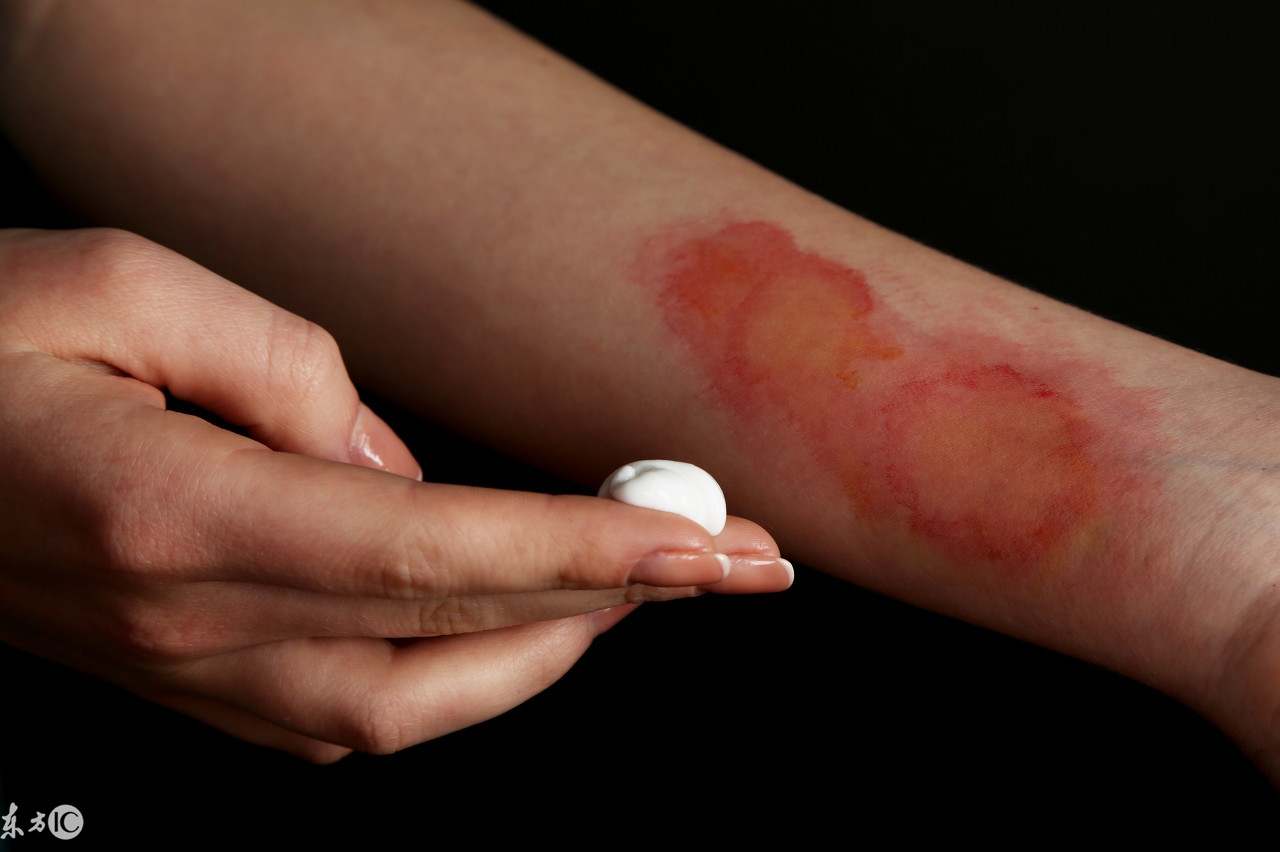 被开水烫伤后该怎么说,被开水烫伤后饮食注意事项