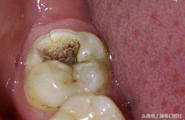 牙齿表面发黑是牙神经坏死吗,牙神经发黑必须拔吗