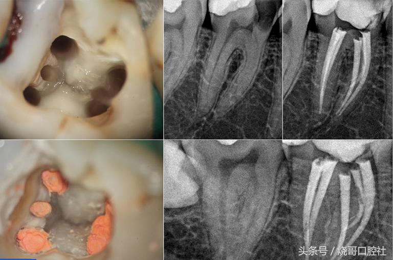 牙齿表面发黑是牙神经坏死吗,牙神经发黑必须拔吗