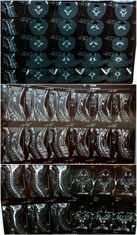 颈椎病头部憋胀怎么办,病人喉咙呼噜呼噜有痰怎么办