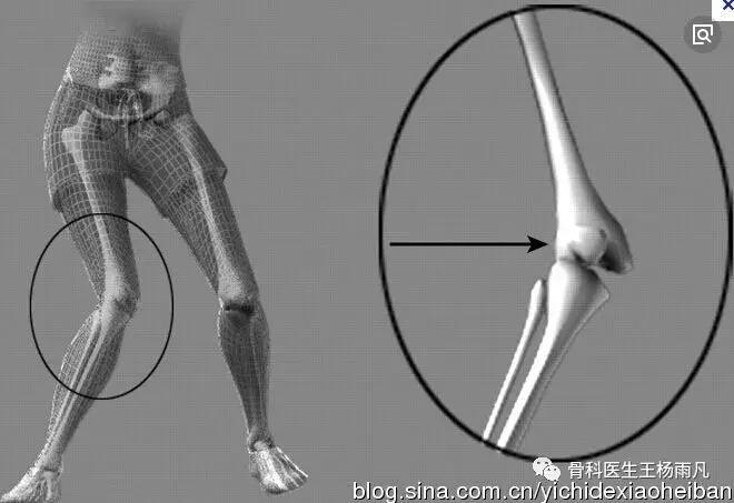前叉韧带损伤最佳治疗方法,前交叉韧带重建后前叉先松后紧