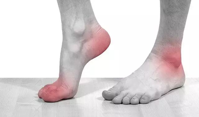 痛风根治的方法2020,痛风如何根治不复发呢