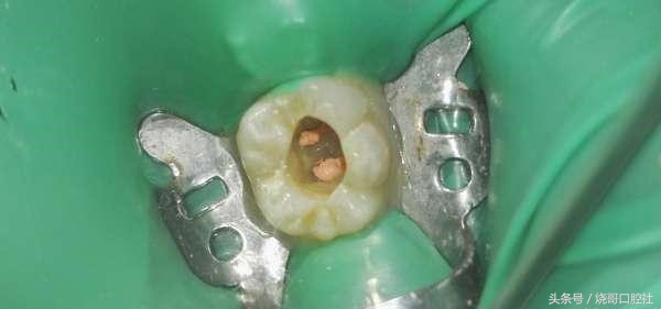 牙齿表面发黑是牙神经坏死吗,牙神经发黑必须拔吗