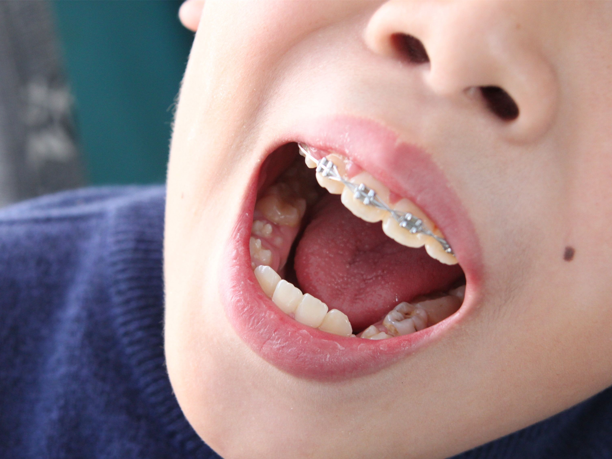 孩子牙齿腐蚀，家长先别忙着责备孩子，只怪你太无知