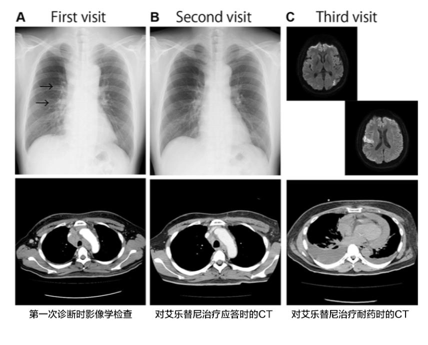 Alk突变患者吃克唑替尼能吃多久,alk抑制剂艾乐替尼