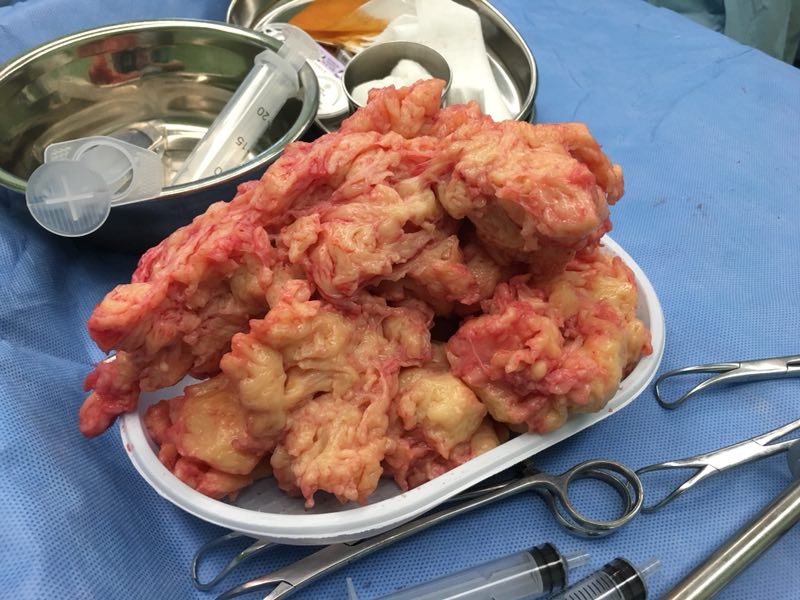 哈医大二院妇产科成功完成两孔腹腔镜下巨大子宫肌瘤切除手术