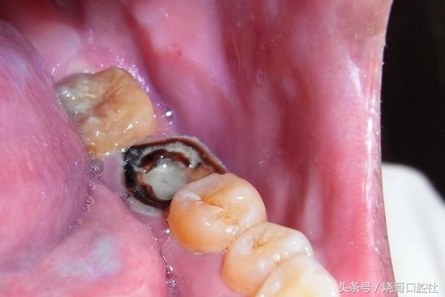 牙齿表面发黑是牙神经坏死吗,牙神经发黑必须拔吗