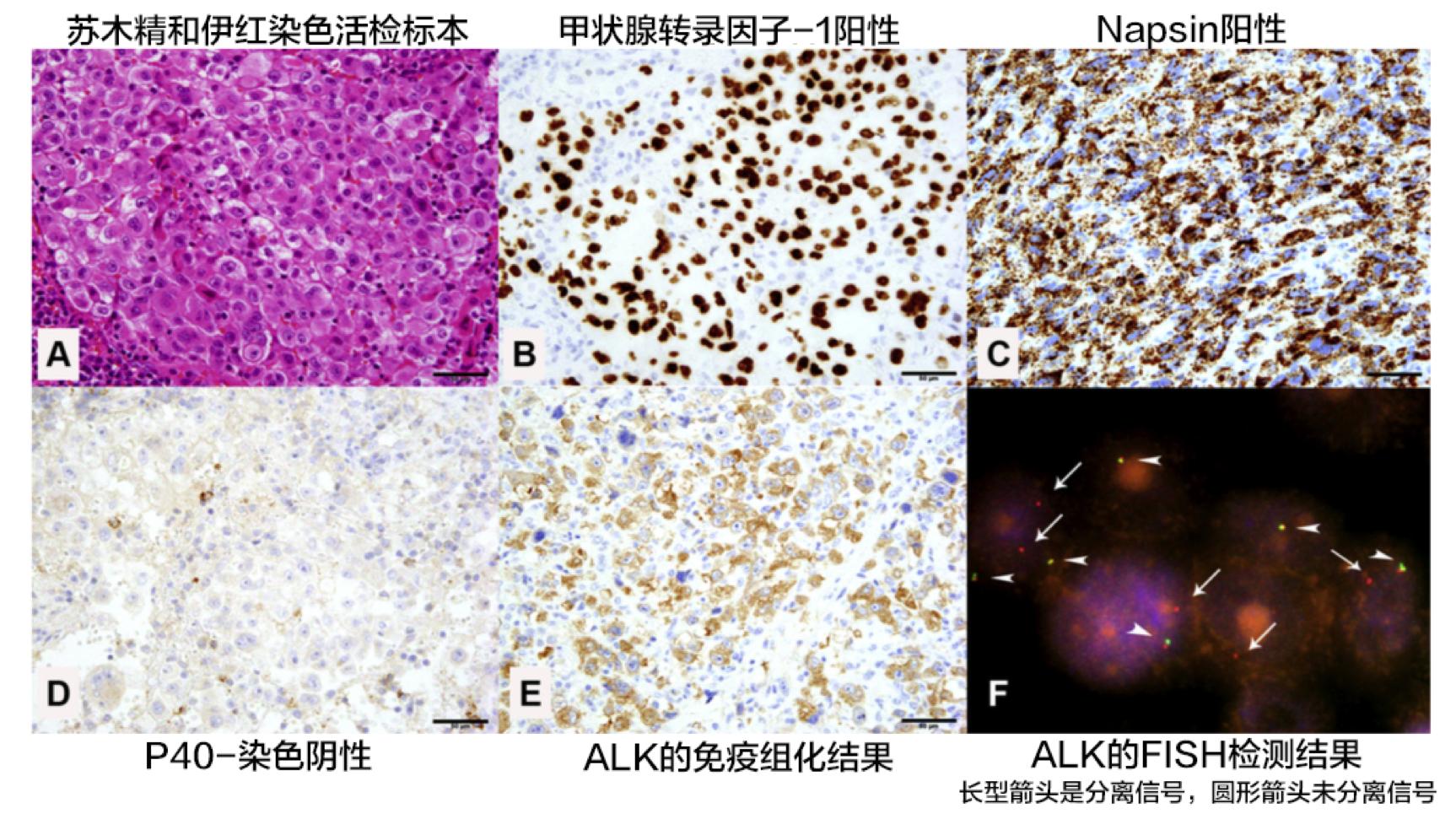 Alk突变患者吃克唑替尼能吃多久,alk抑制剂艾乐替尼