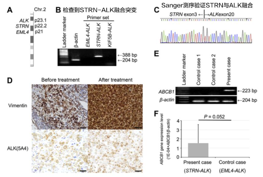 Alk突变患者吃克唑替尼能吃多久,alk抑制剂艾乐替尼