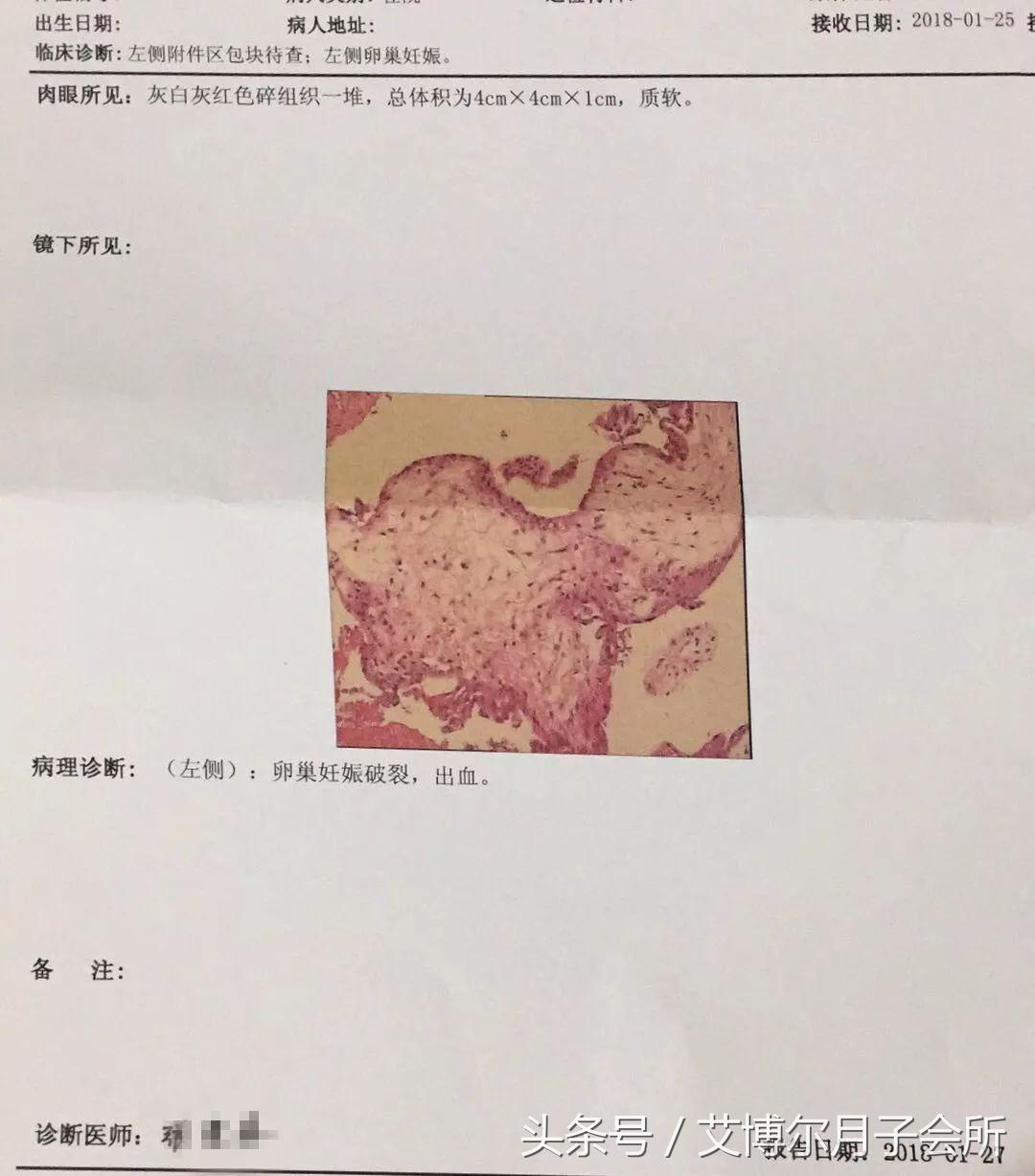 宁波女子遇罕见宫外孕,胎儿竟长在卵巢!发生率仅5万分之一!