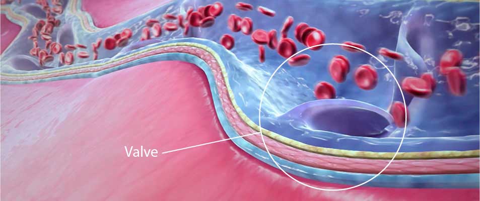 静脉曲张的微创治疗是怎么回事,治疗静脉曲张的新技术有哪些
