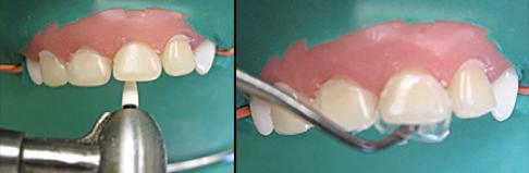 前牙光固化美容修复的方法,乳前牙预成冠修复过程
