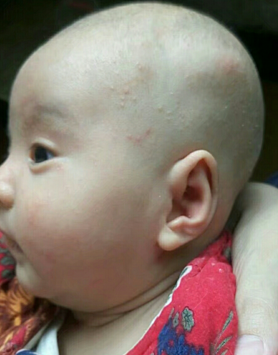 宝宝反复长湿疹怎么办啊,宝宝痤疮反反复复是怎么回事