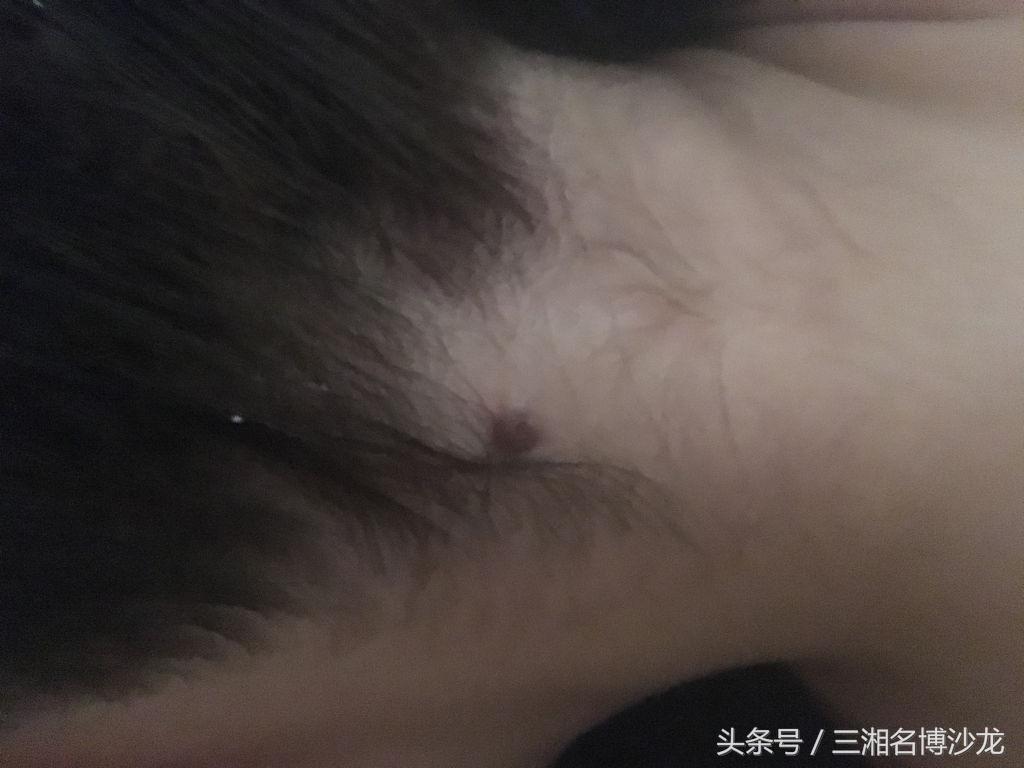 土办法治疗头皮炎,土方法治头痒