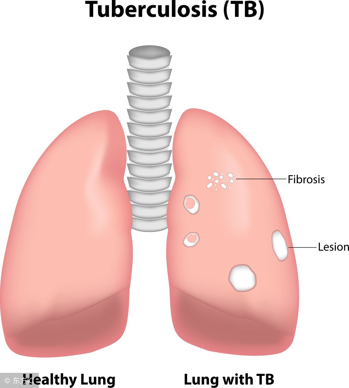 肺结核具有传染性时有什么症状,肺结核有什么症状表现会身上疼
