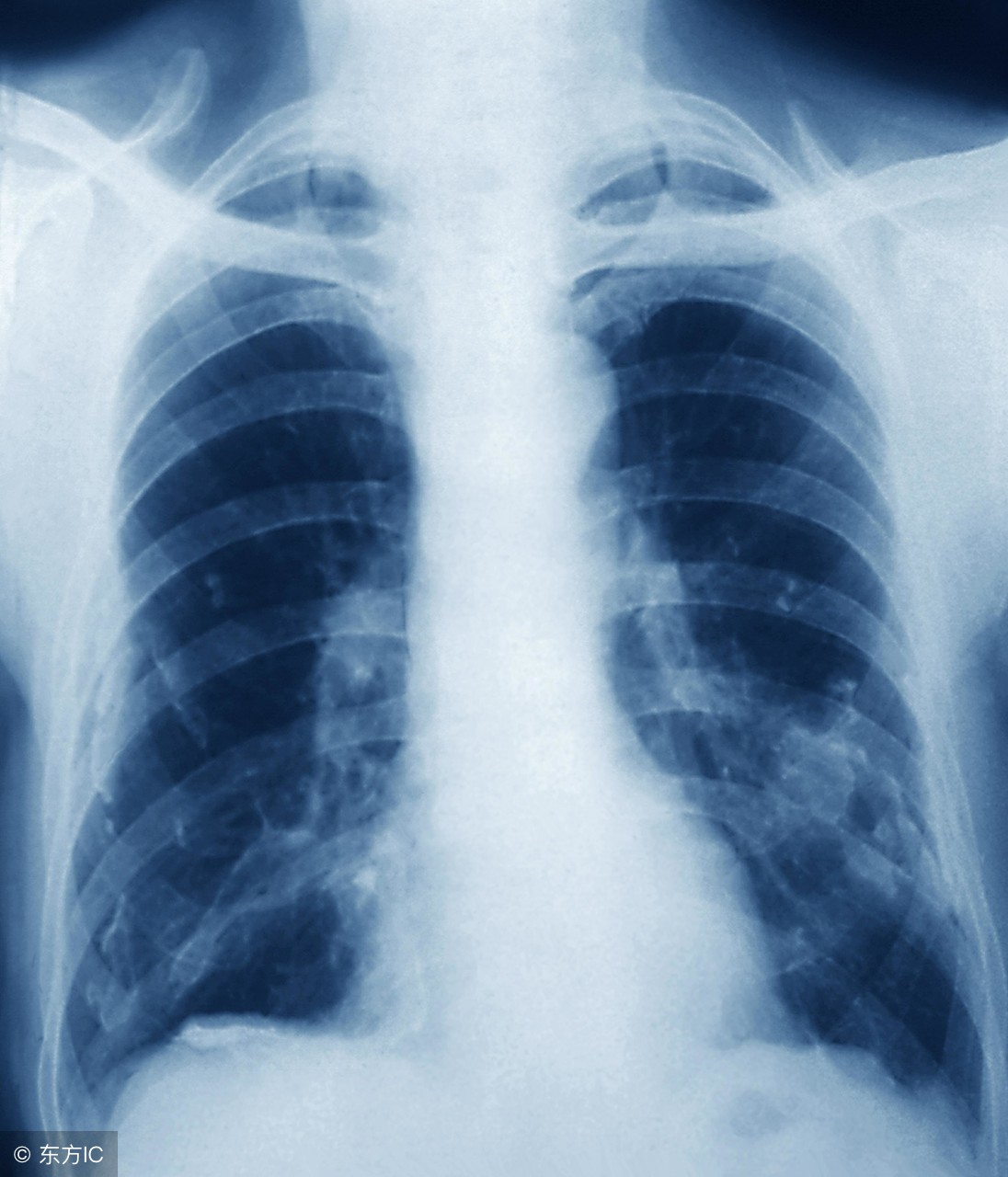 肺结核具有传染性时有什么症状,肺结核有什么症状表现会身上疼