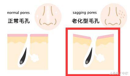 肌肤松弛显毛孔粗大用什么产品,老化型毛孔粗大如何改善小技巧