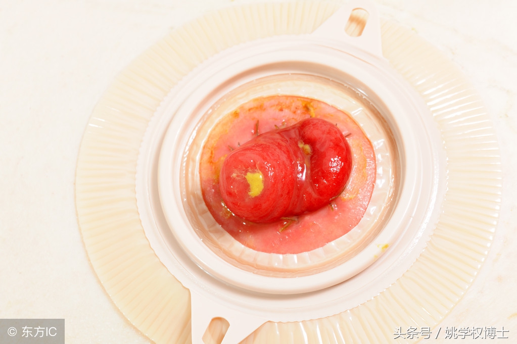 失肛之痛有多痛？告诉你活人怎样不被便便憋憋憋死