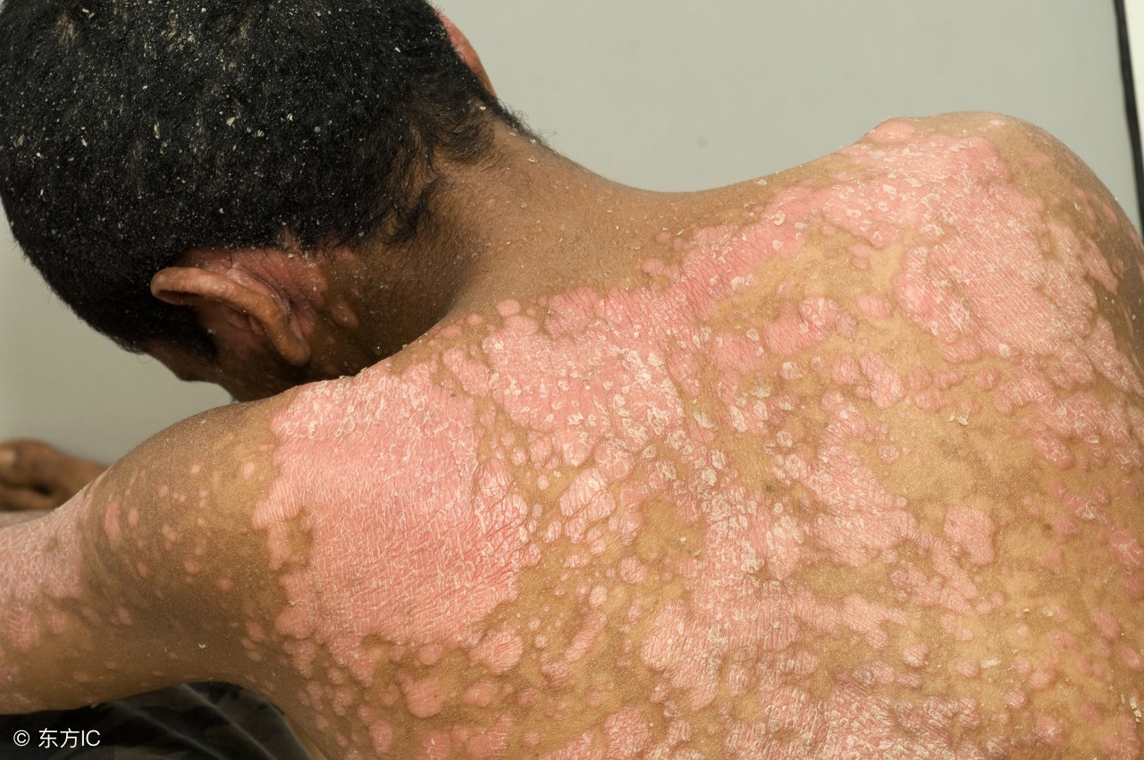 遗传性鱼鳞病怎么治疗,遗传性鱼鳞病能治好吗