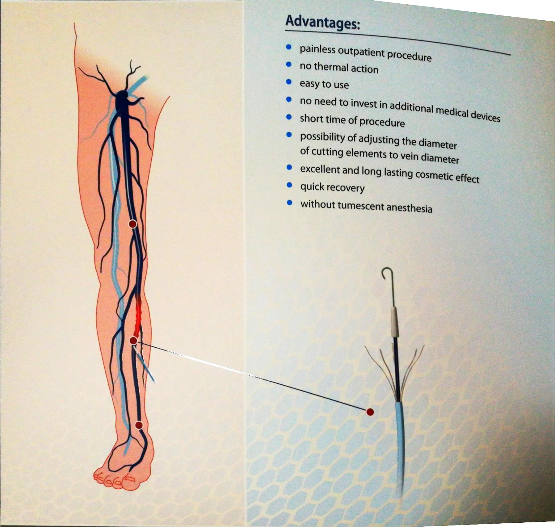 静脉曲张的微创治疗是怎么回事,治疗静脉曲张的新技术有哪些