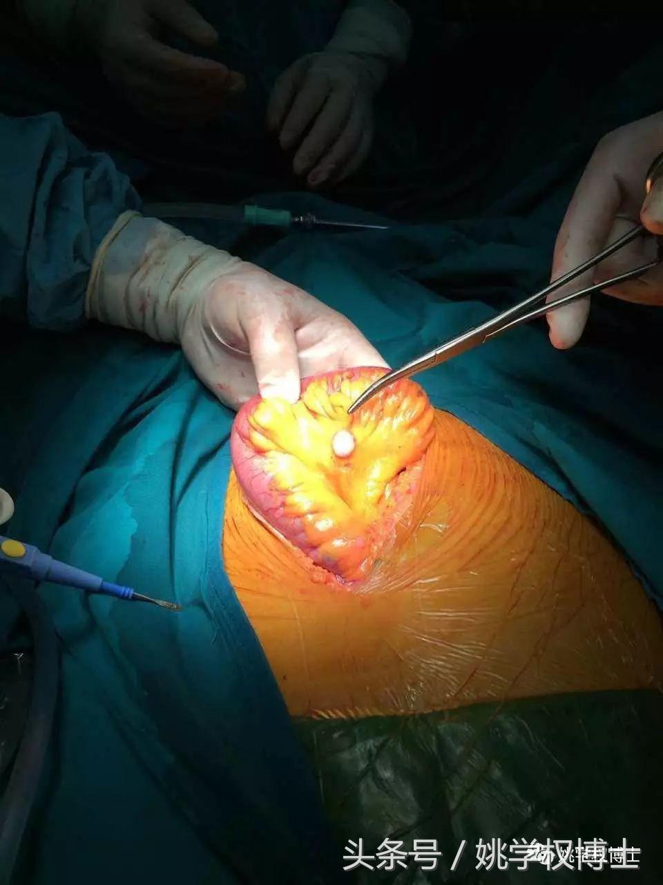 失肛之痛有多痛？告诉你活人怎样不被便便憋憋憋死