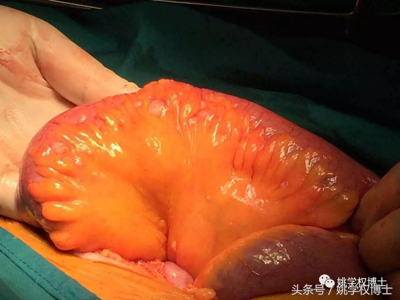 失肛之痛有多痛？告诉你活人怎样不被便便憋憋憋死