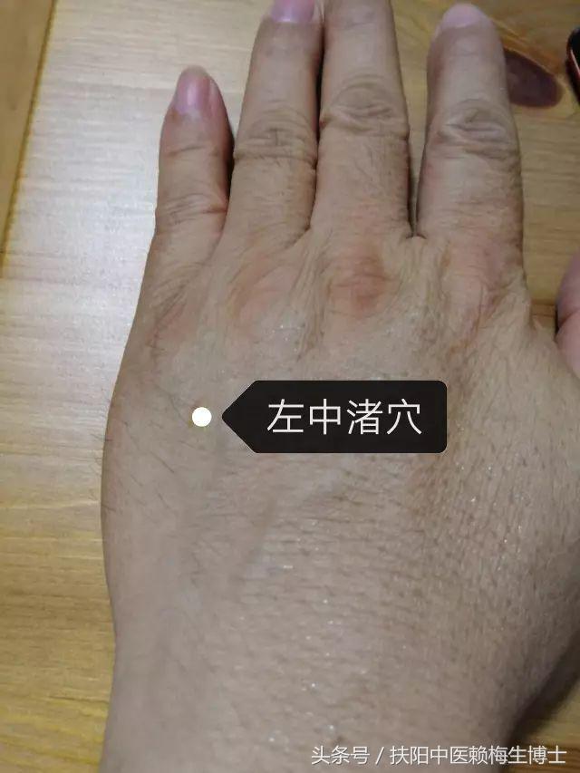 黄帝内针治疗手指关节痛医案,黄帝内针治疗腰疼医案