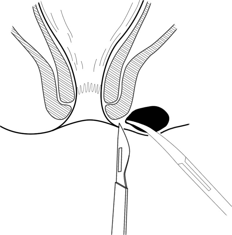 肛肠最新技术,人活一世难免会遇到各种糟心的事