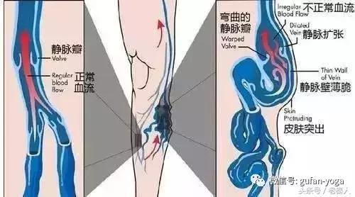腿麻腿部静脉曲张瑜伽动作,静脉曲张瑜伽怎么理疗