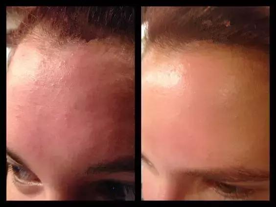 AnnaG教你整|丰额头,能增加运气吗?