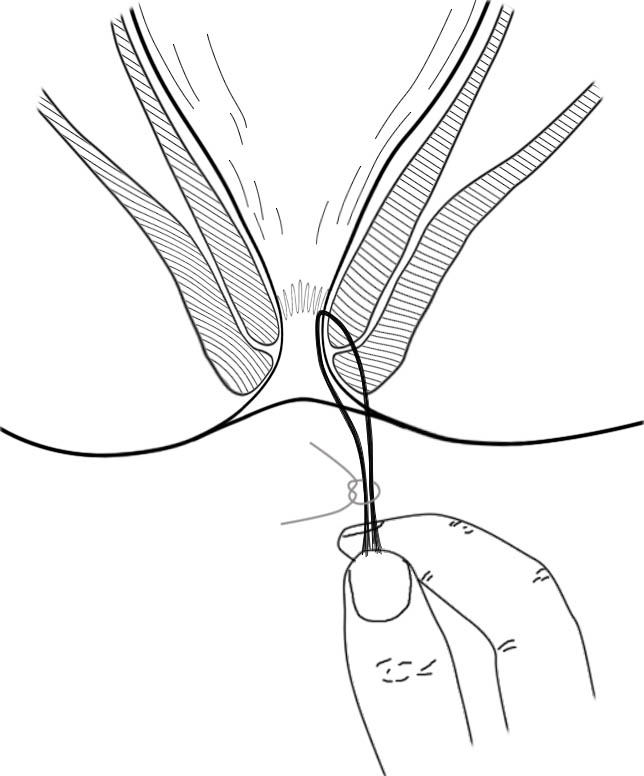 肛肠最新技术,人活一世难免会遇到各种糟心的事