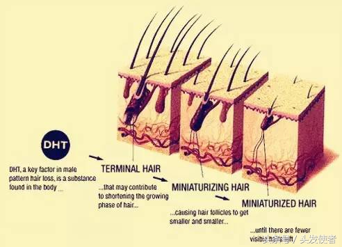油脂堵塞毛囊导致脱发图片,脱发是因为毛囊油脂茂盛吗