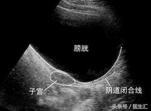 病例分析原发闭经的诊断思路,临床诊断53岁女性闭经