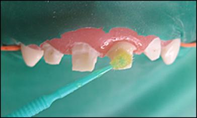 前牙光固化美容修复的方法,乳前牙预成冠修复过程