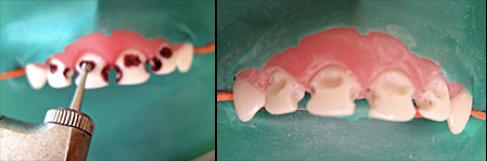 前牙光固化美容修复的方法,乳前牙预成冠修复过程