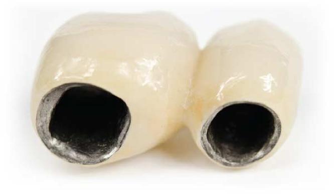 烤瓷牙修复一般要多久,烤瓷牙能彻底恢复牙齿吗