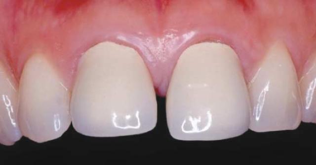 烤瓷牙修复一般要多久,烤瓷牙能彻底恢复牙齿吗