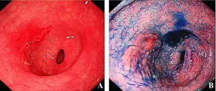 常见的内镜染色方法原理、内镜下表现