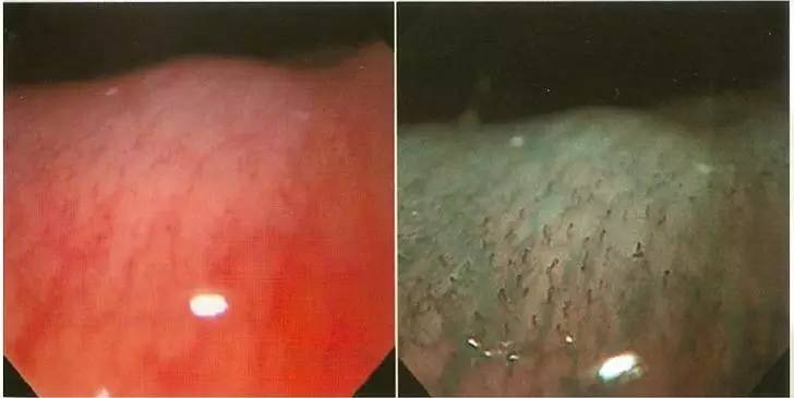 常见的内镜染色方法原理、内镜下表现